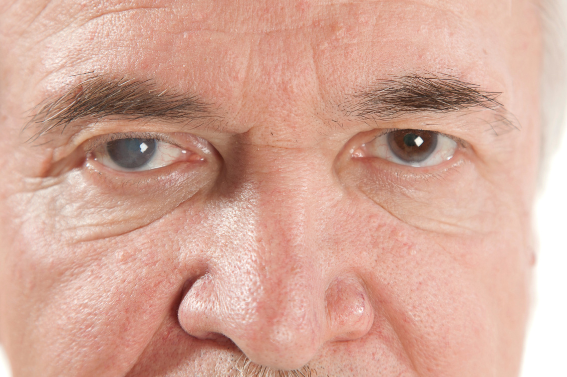 Начальная стадия катаракты